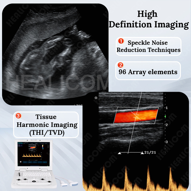 HUC-190 Hospital Portable Color Doppler Ultrasound System