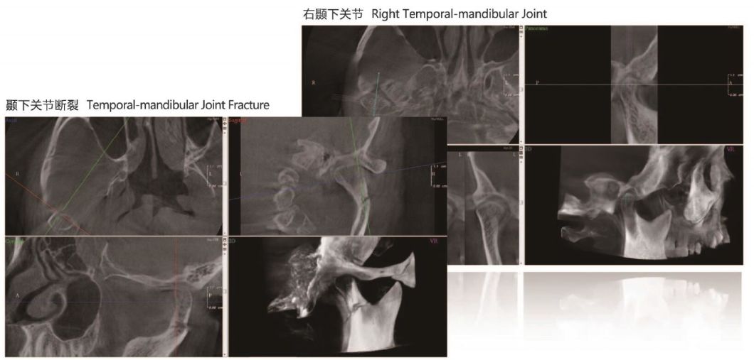 H-X9010dpro-2D-Digital-Panoramic-Dental-X-ray-Machine (8)