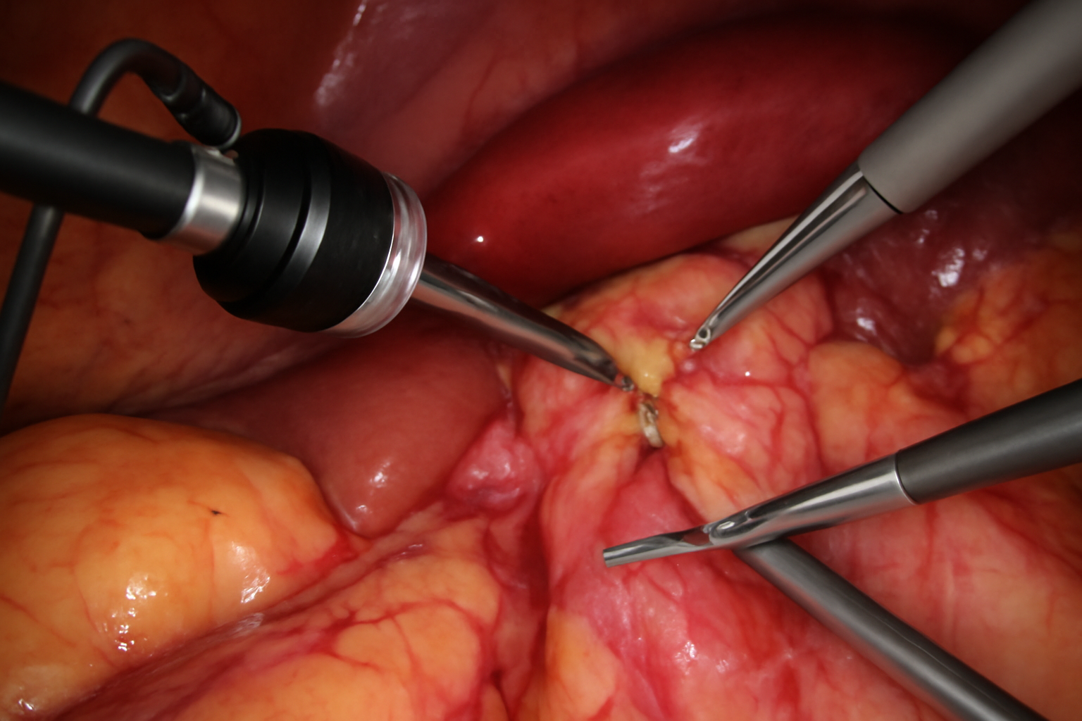 Laparoscopic Abdominal Surgeries